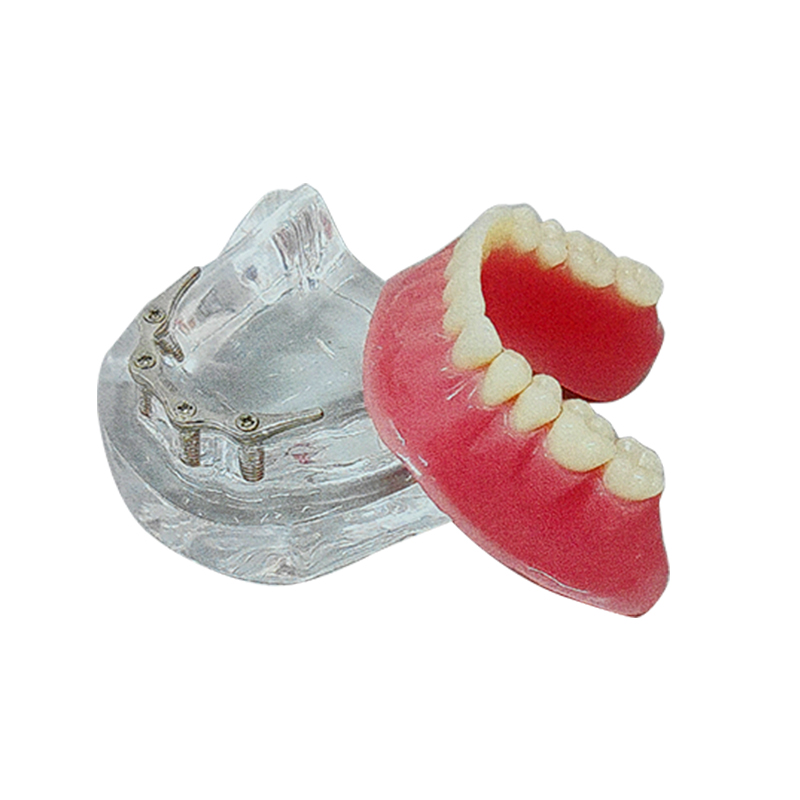 UM-6009 Implant có gắn kèm kẹp
   