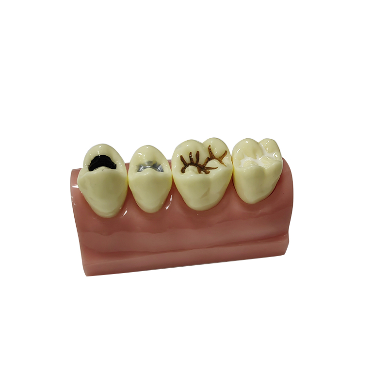 UM-F17 Sealant and Inlay Demonstration Model